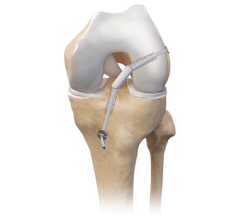 ACL Backup Fixation System