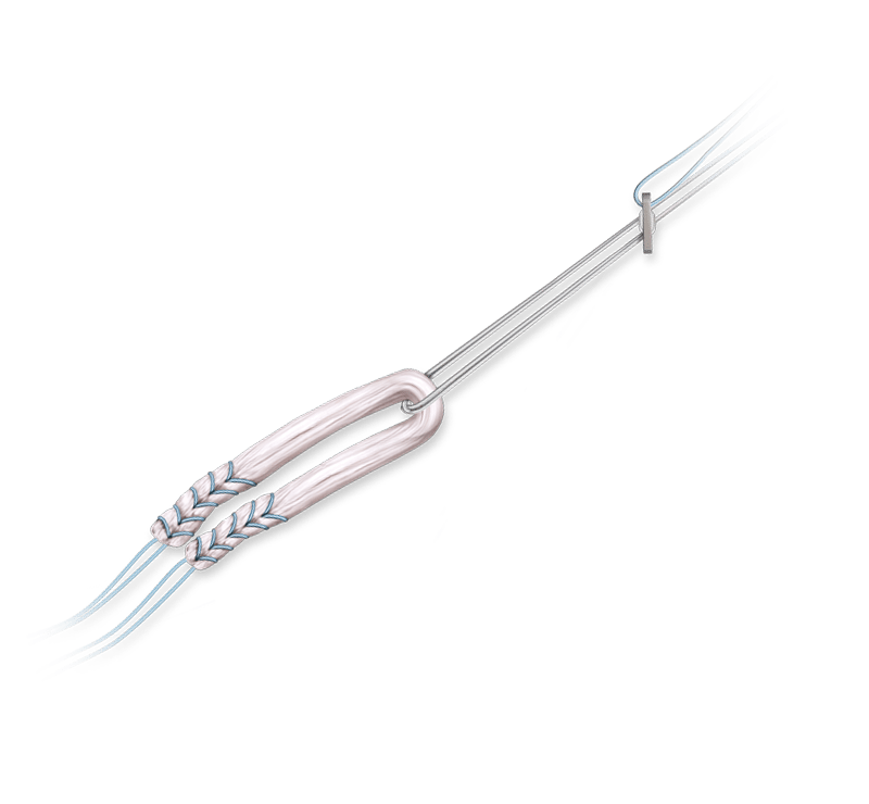 Knee Ligament Fixation Devices