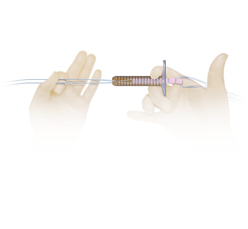 Transplantatkompressions- <br>hülsenset