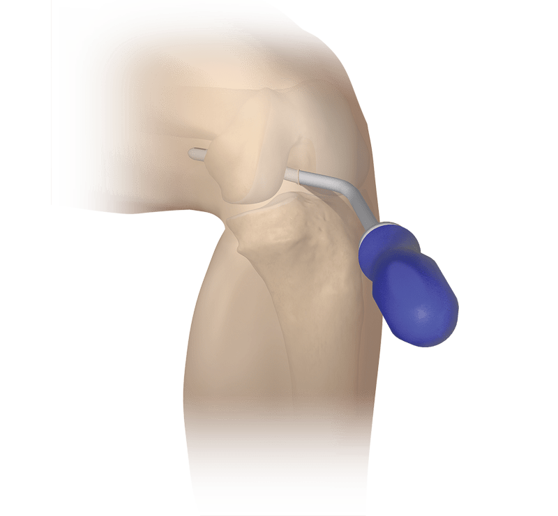 Obturador de rodilla para portales posteriores