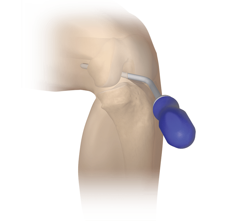 Knee Obturator for Posterior Portals