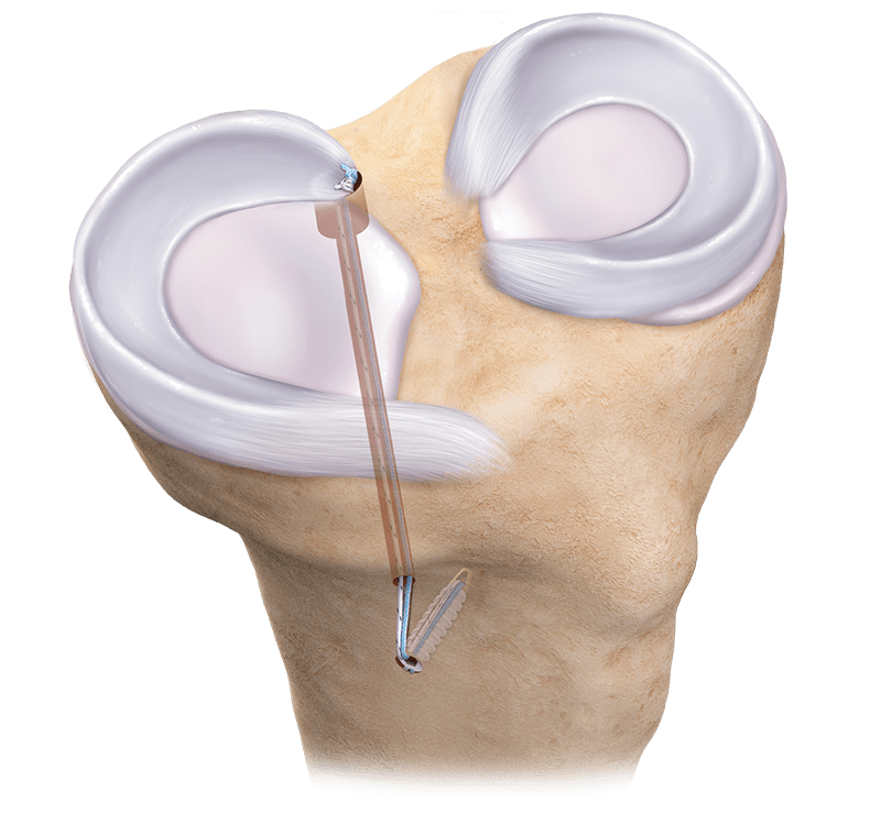 Reparación de raíz meniscal