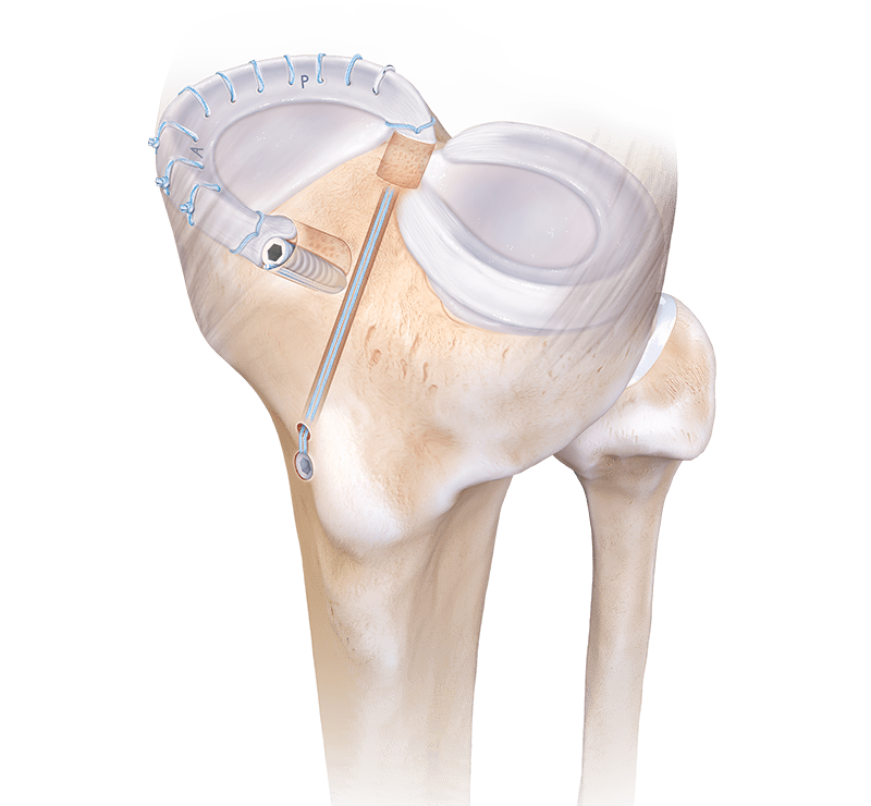 Meniscal Transplant Systems