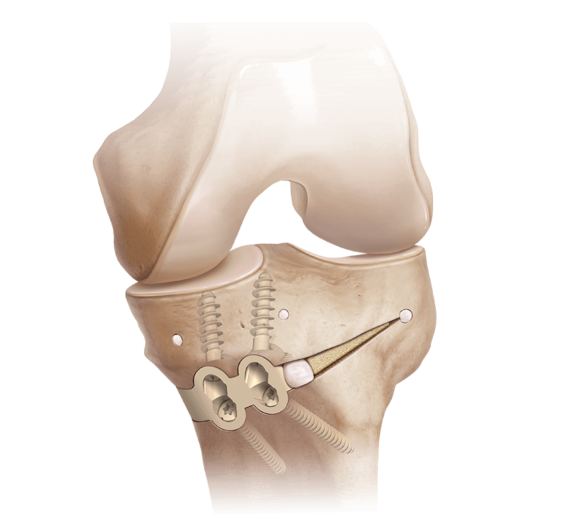 Osteotomy