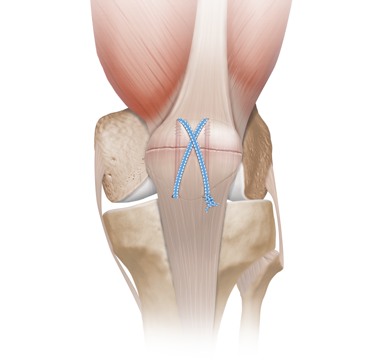 Patella Fracture System