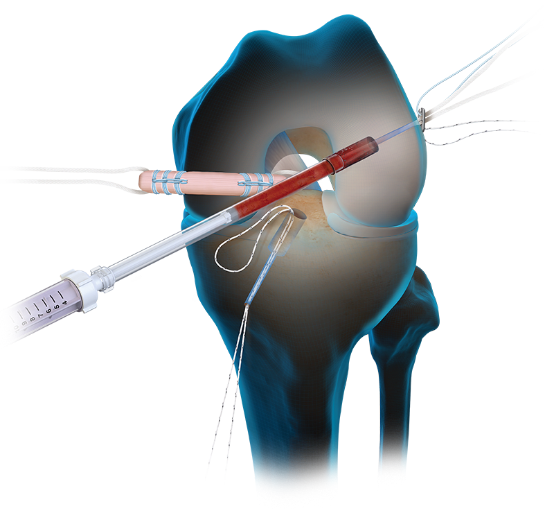 Die BioACL™-Technik