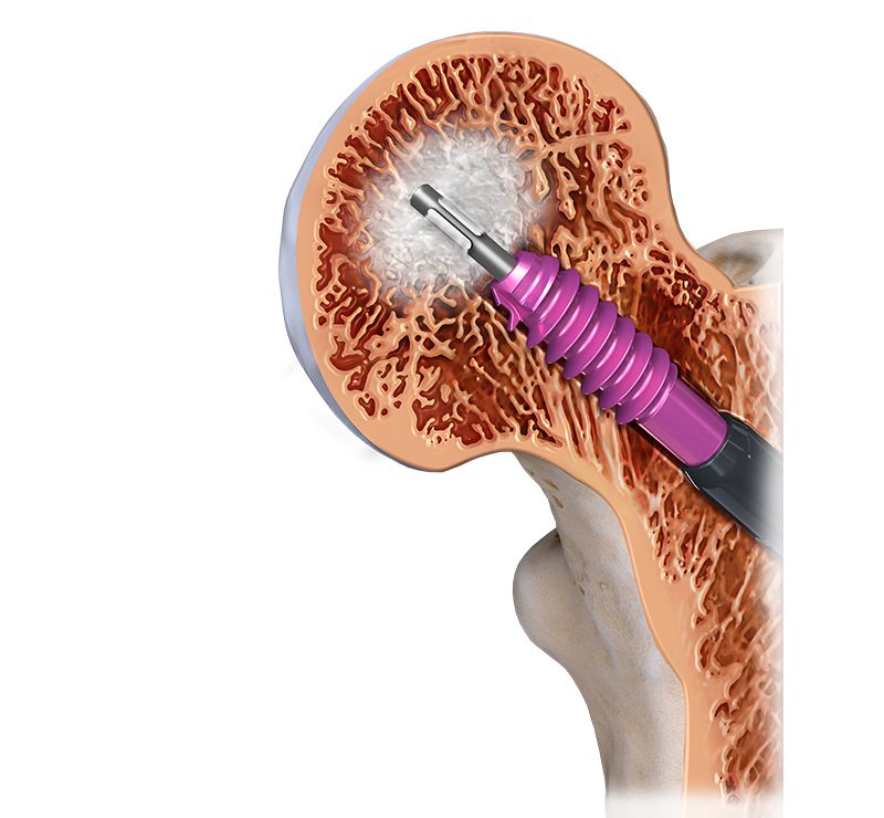 Trochanteric Nail Biologic Augmentation