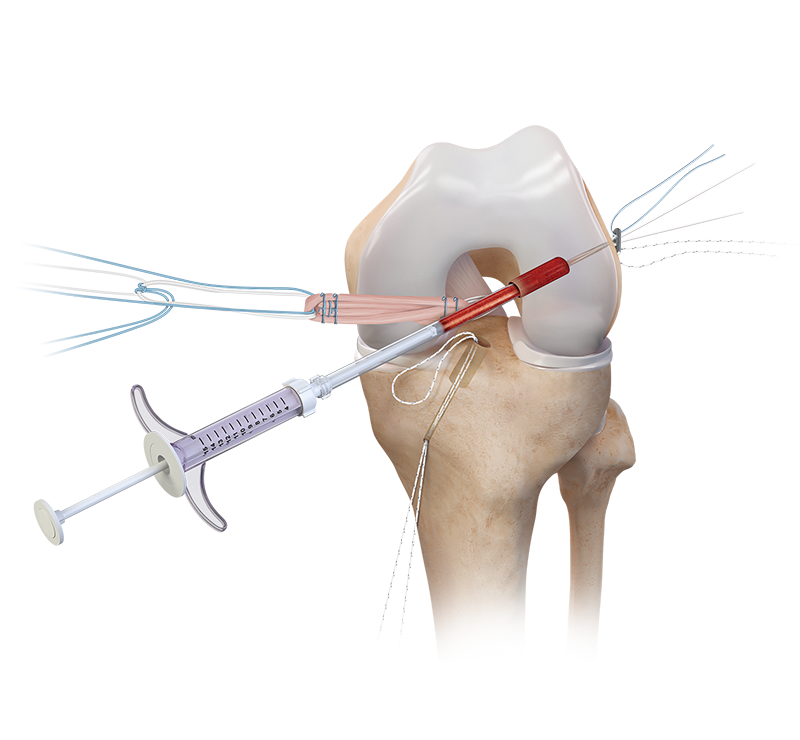 Técnica BioACL™ 