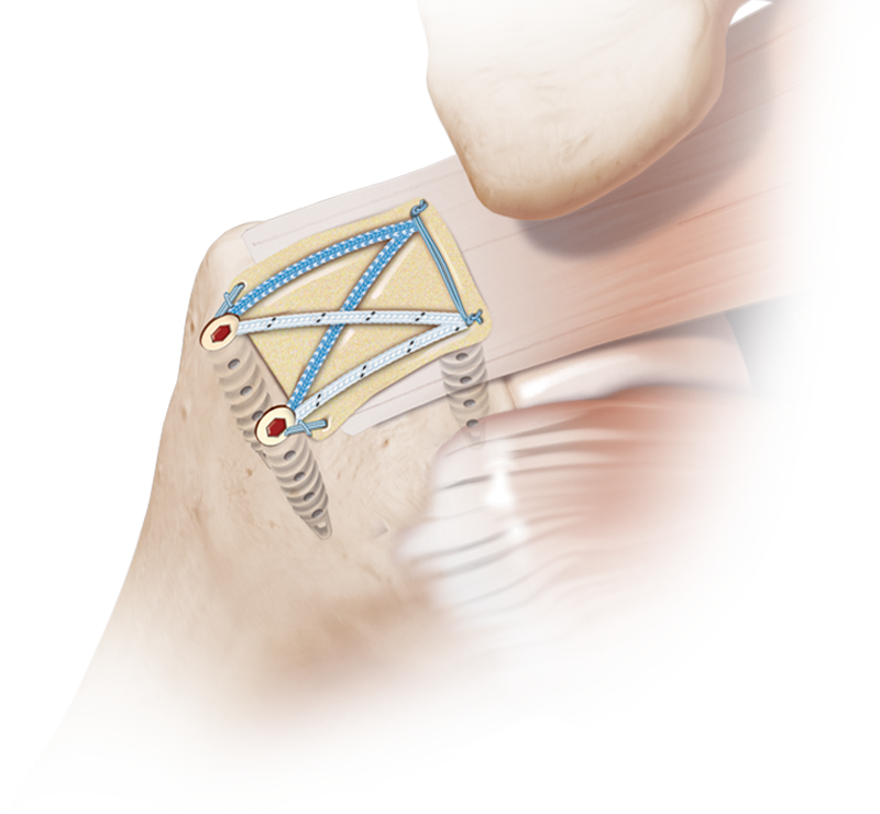 Matriz de refuerzo Arthrex DX