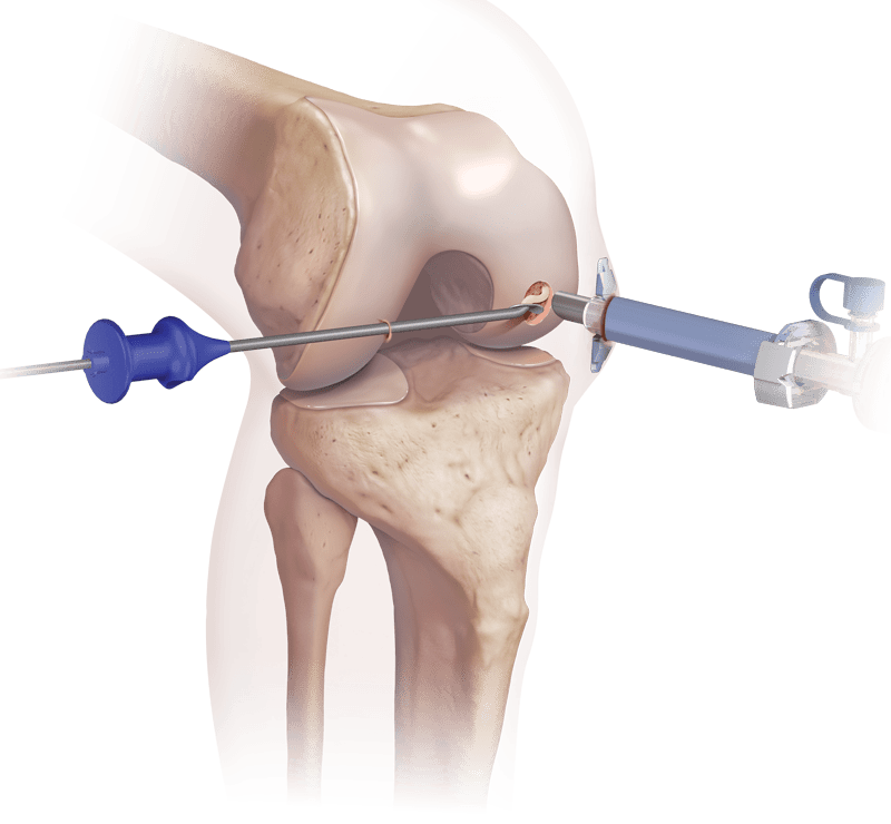 BioCartilage<sup>®</sup>: matriz de cartílago micronizado