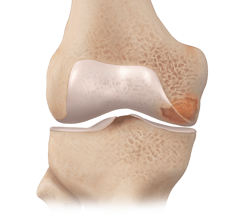 IntraOsseous BioPlasty<sup>®</sup> (IOBP) Technique