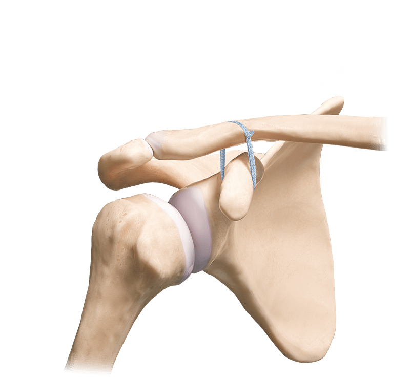 AC FiberTape® Cerclage Technique