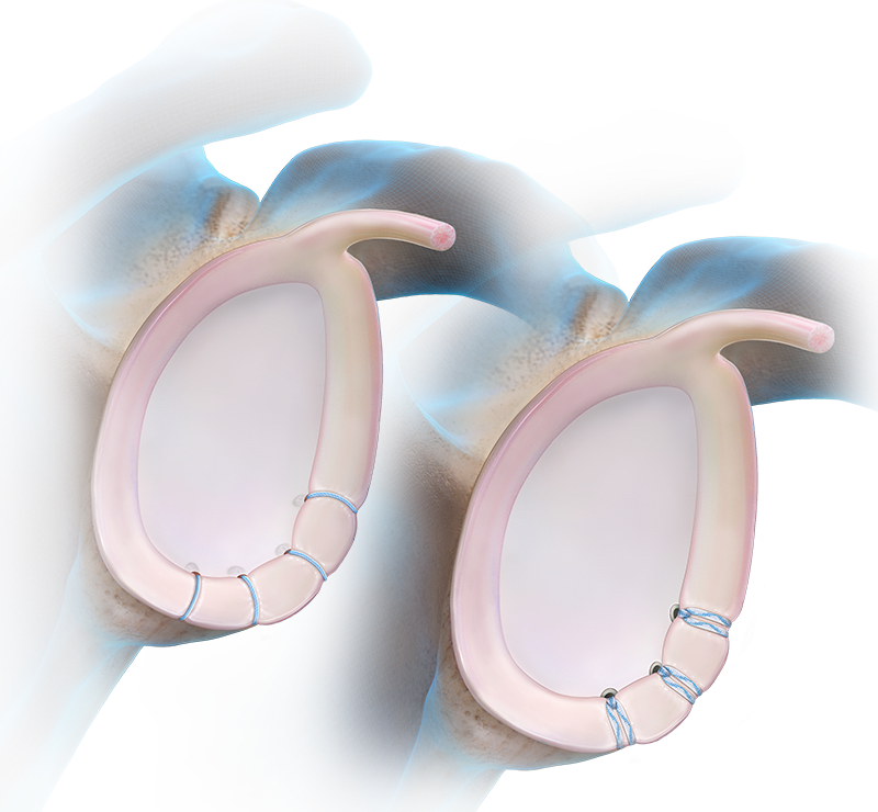 Anterior Labral Repair