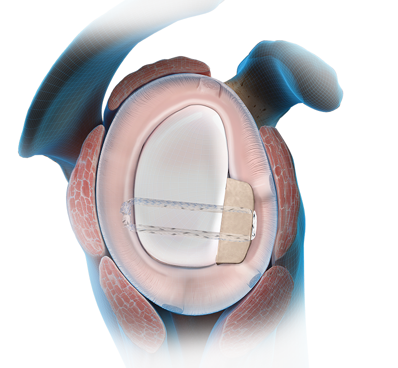 Bone Block Cerclage