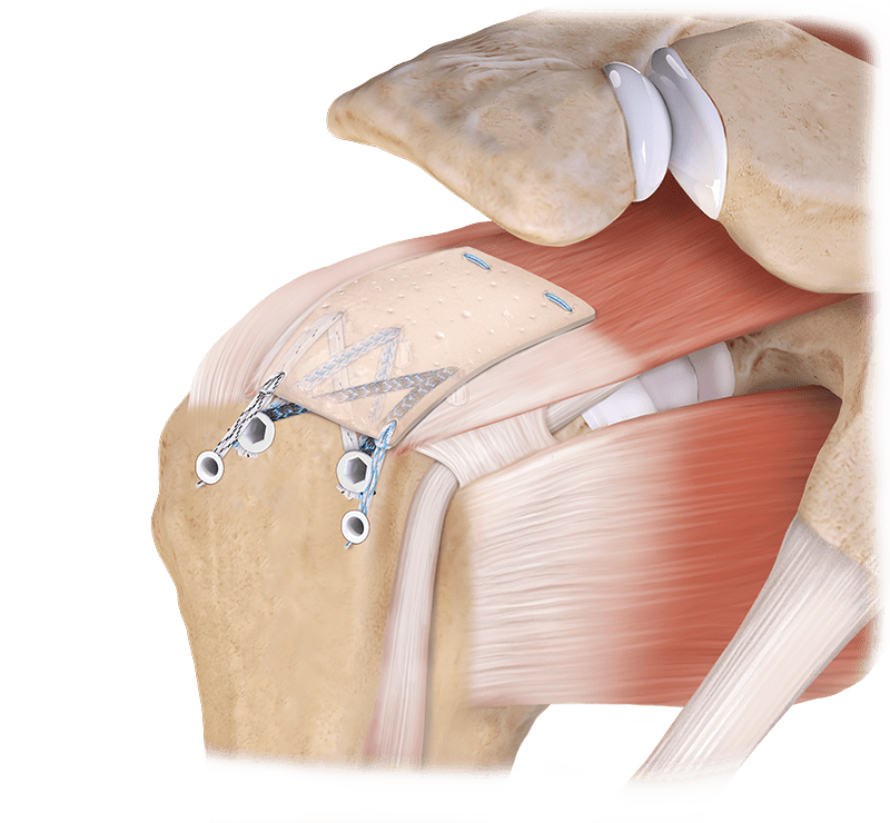 Técnica CuffMend™ para manguito rotador