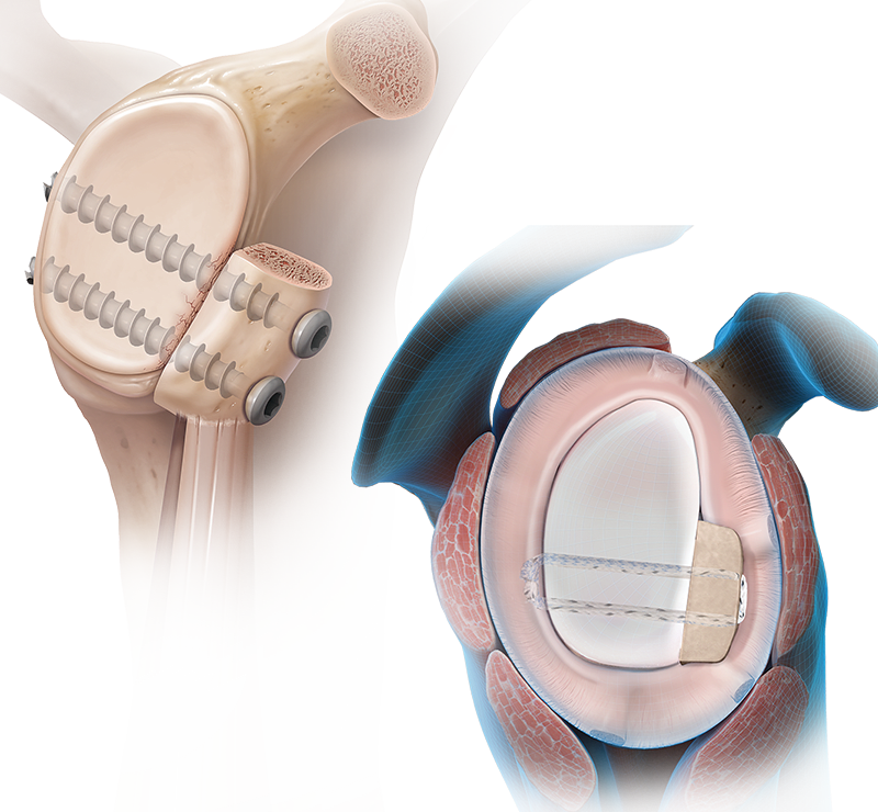 Glenoid Bone Loss
