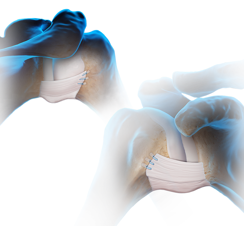 HAGL and RHAGL Lesion Repair