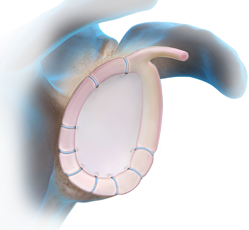 Knotless FiberTak® Soft Anchor Technique - MDI