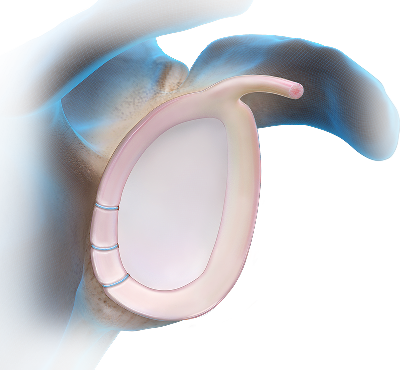 Knotless Fibertak® Soft Anchor Technique - Posterior