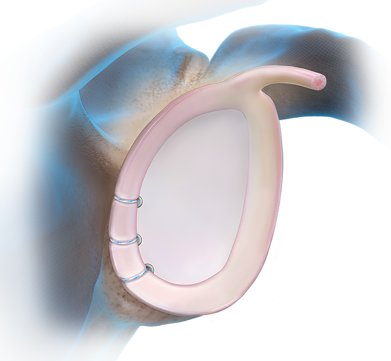 Knotless SutureTak® Anchor Technique - Posterior