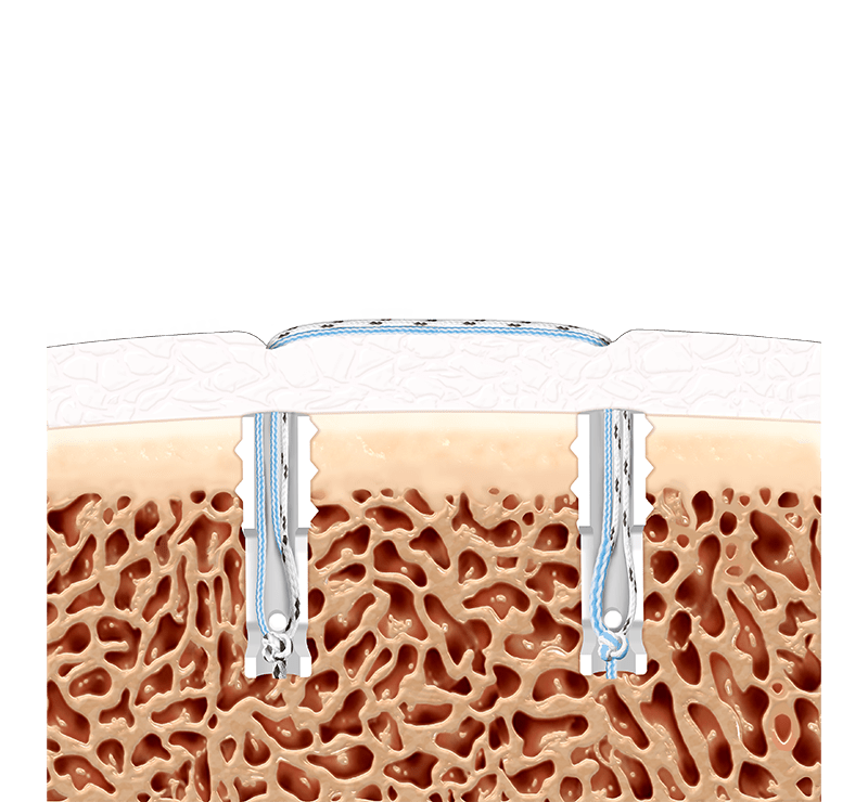Knotless Corkscrew® Anchor Technique - Remplissage