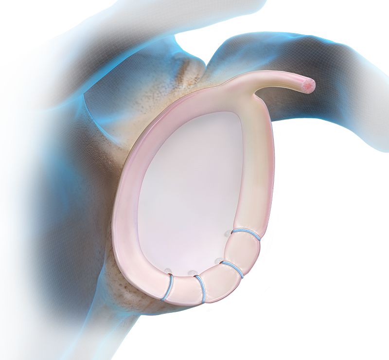 Knotless FiberTak® Soft Anchor Technique - Anterior
