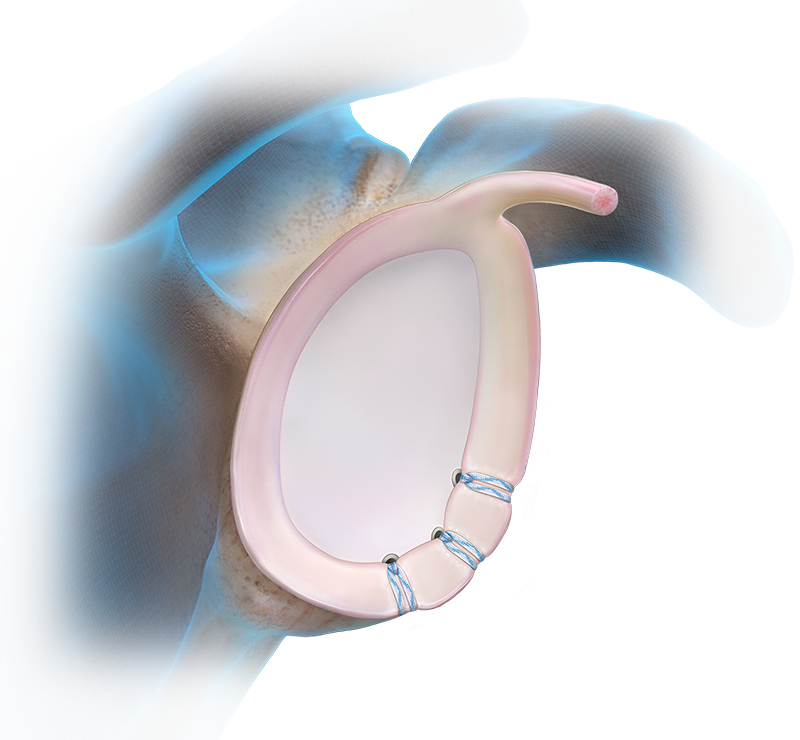 PushLock® Anchor Technique - Anterior