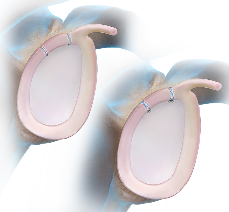 SLAP Repair