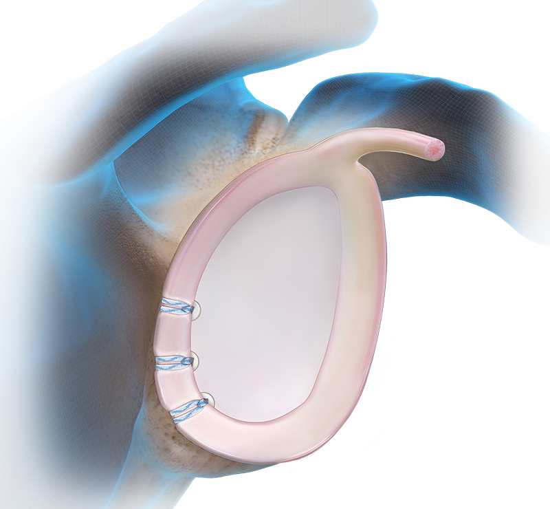 SwiveLock® Instability Technique - Posterior