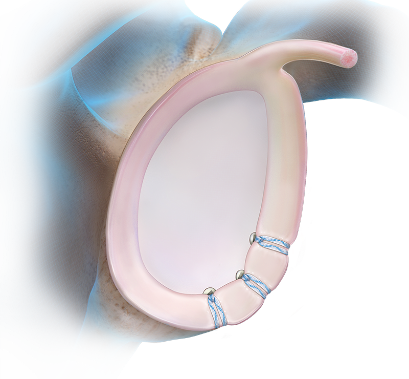 SwiveLock® Instability Technique - Anterior