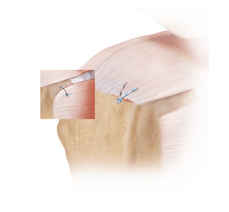 Double-Loaded Tensionable Knotless Anchors for Rotator Cuff Repair