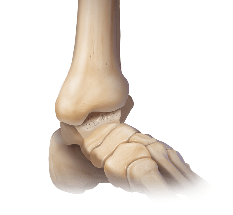 Ankle Osteoarthritis