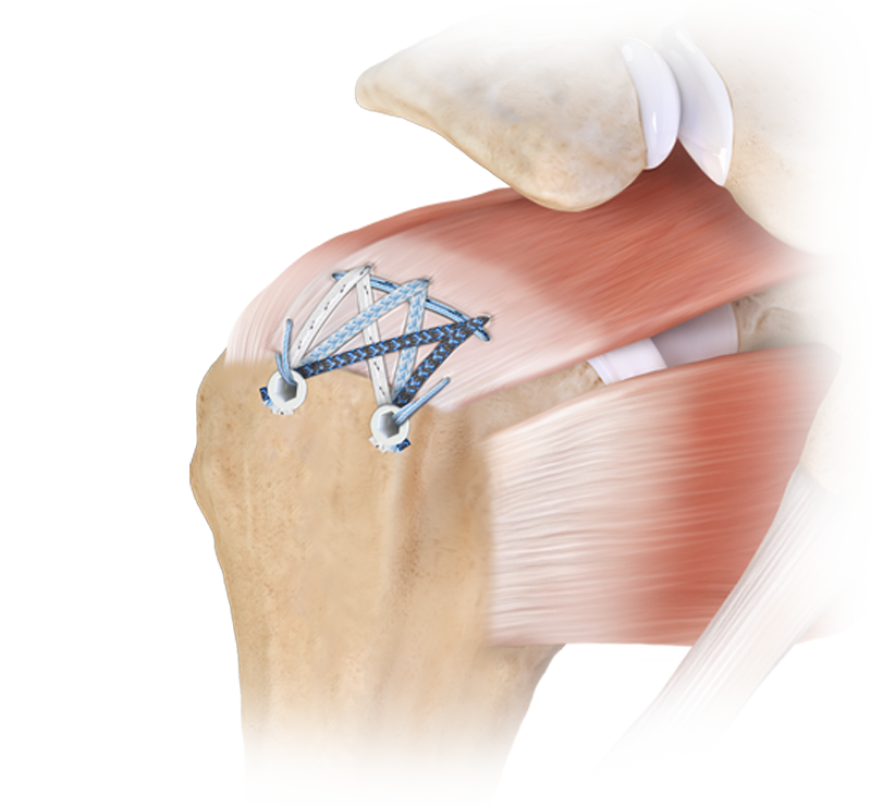 Knotless Rotator Cuff Repair