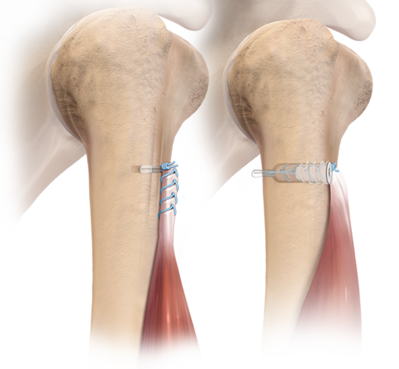 Técnica para tenodesis con FiberTak<sup>®</sup>