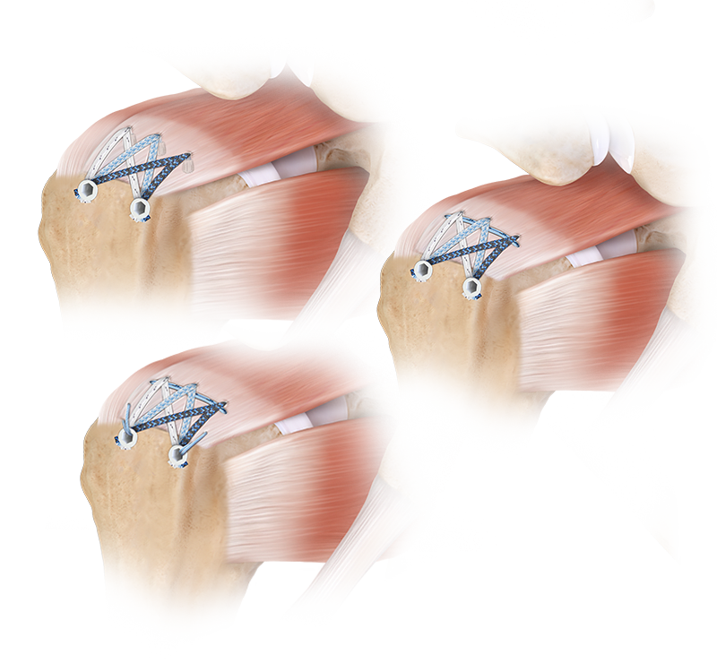 FiberTak® SpeedBridge™-Rotatorenmanschettenrekonstruktion