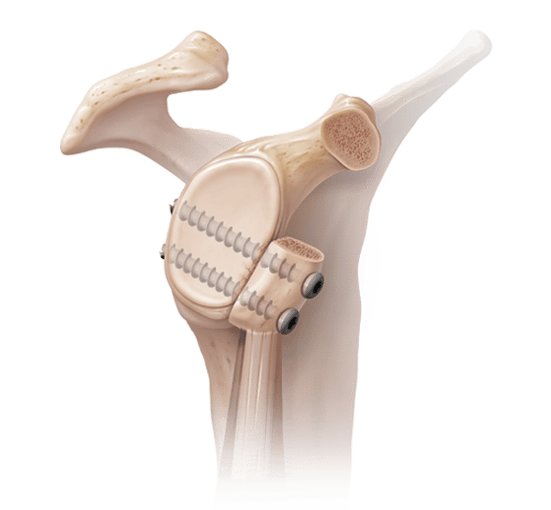 Labral Tear 