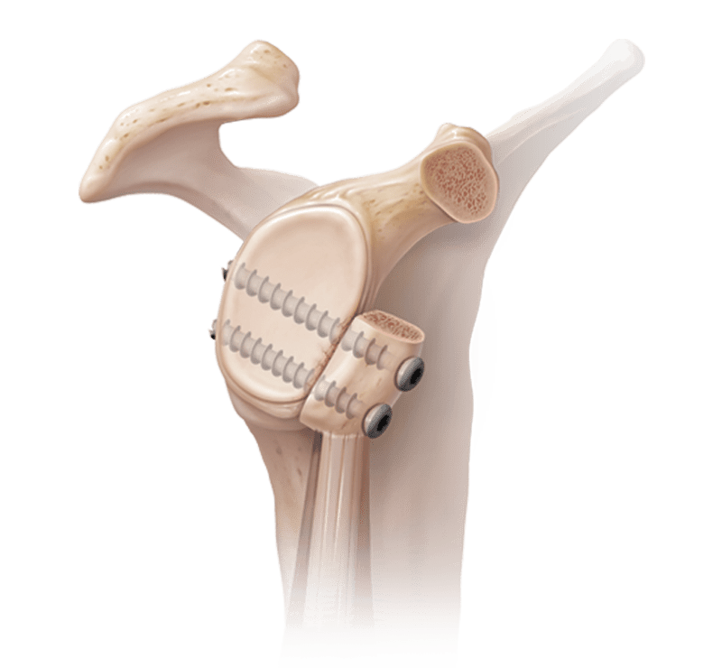 Latarjet/Coracoid Process Transfer for Glenoid Deficiency