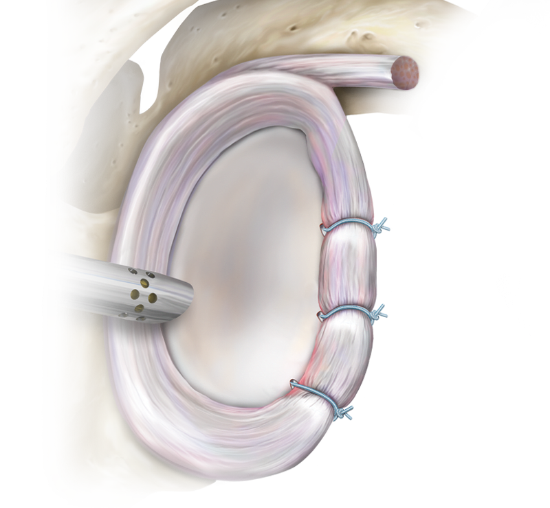 Knot Tying Labral, Instability, ALPSA and HAGL Lesion Repair