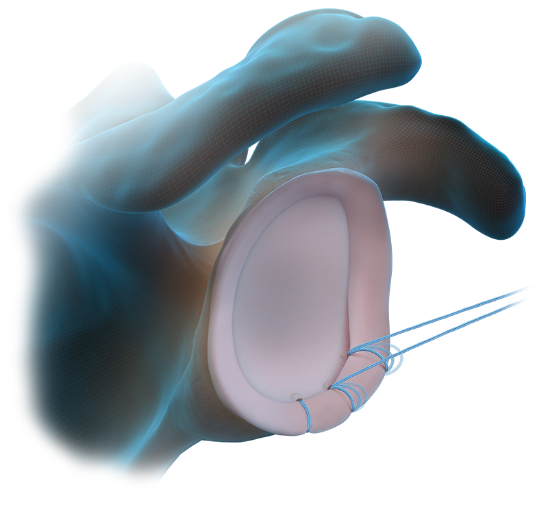 Técnica com âncora FiberTak<sup>®</sup> sem nós para tecidos moles