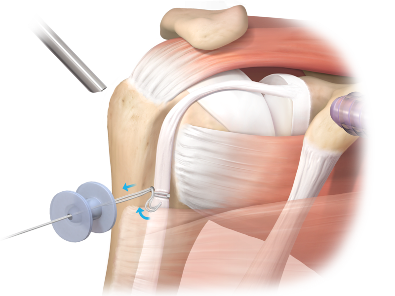 Técnica sin nudos para tenodesis TensionTight™