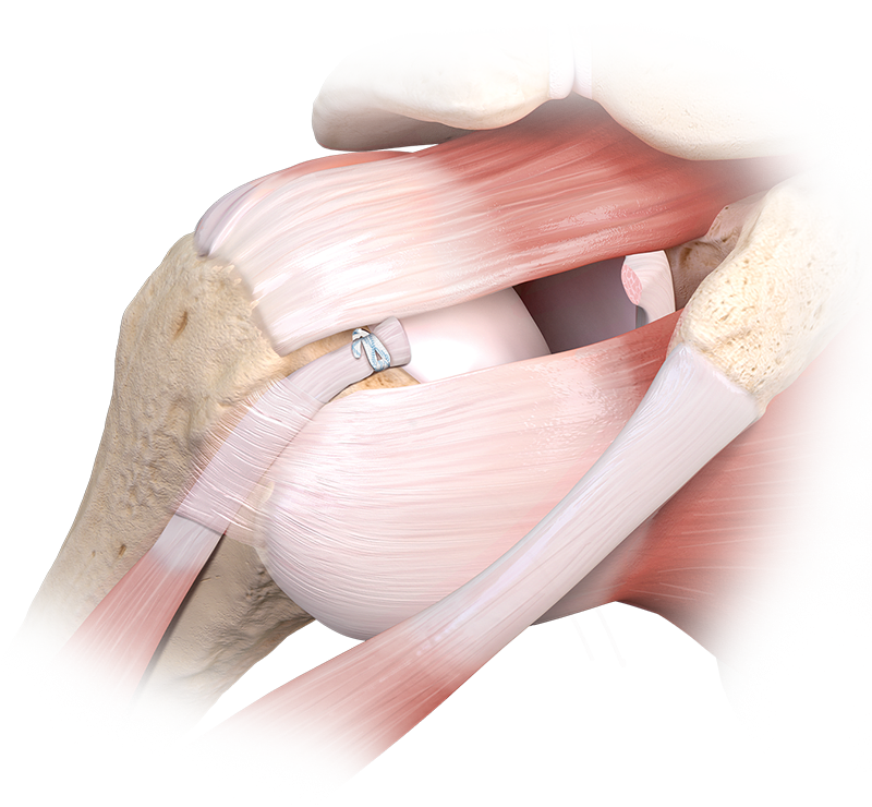 Loop 'N' Tack™ Biceps Tenodesis Technique