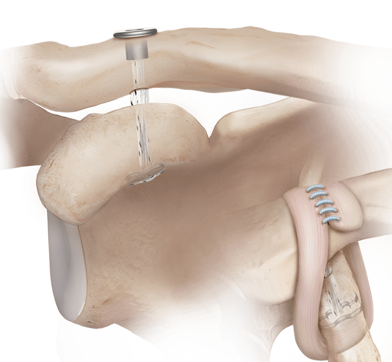 Técnica de tensão ajustável de baixo perfil para reparo acromioclavicular