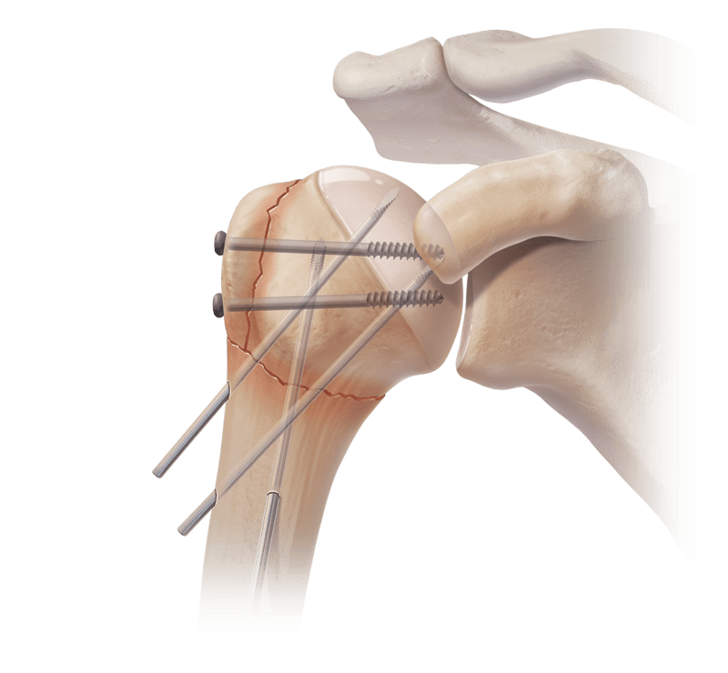 Percutaneous Pinning Technique