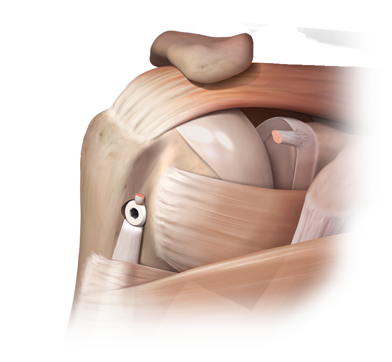 Proximal Biceps Pathology