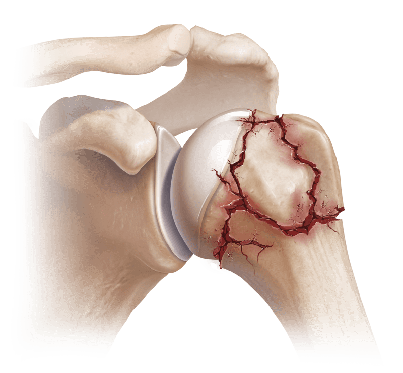 Fractura del húmero proximal