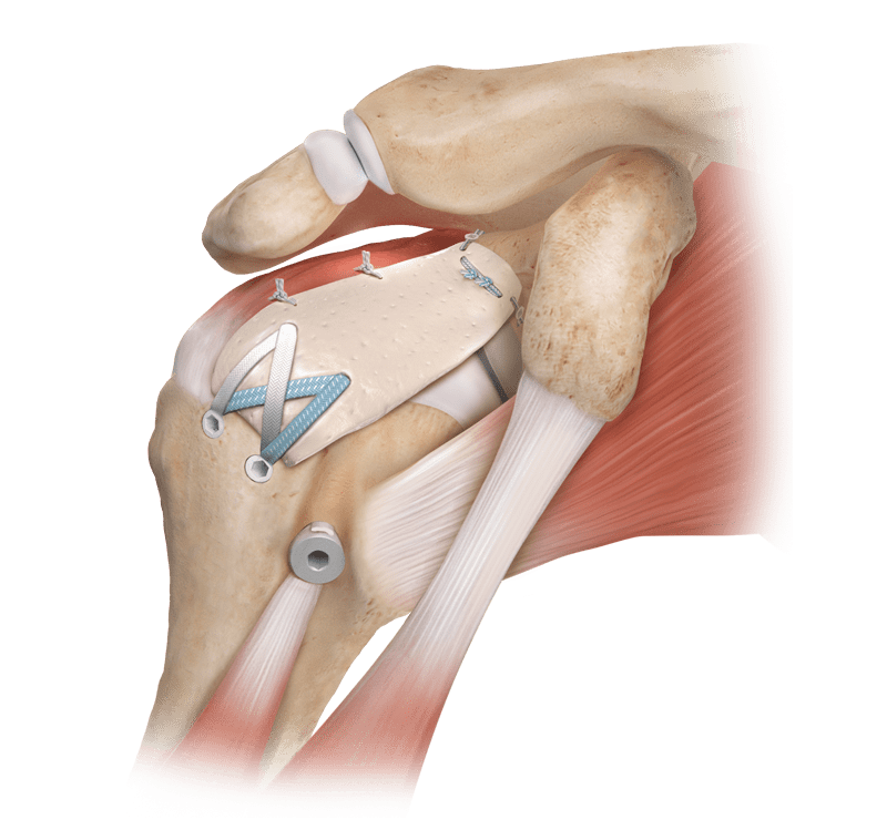 Superior Capsular
 Reconstruction (SCR)