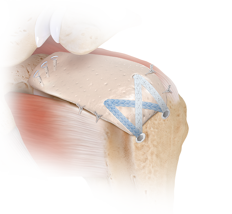 Superior Capsular Reconstruction (SCR) Technique