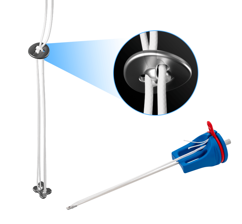 Knotless AC TightRope® Repair System