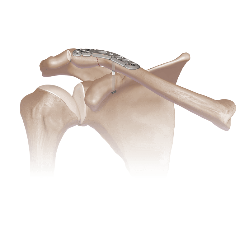 Clavicle Plates and Screws