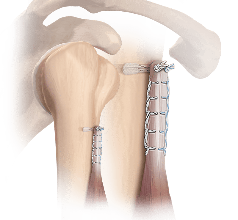 FiberTak<sup>®</sup> Biceps Tenodesis